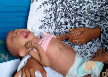 Penderita Gizi Buruk di Tinumbu, Butuh Uluran Tangan Dermawan